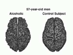 brain diagram that shows the importance of alcohol addiction treatment 